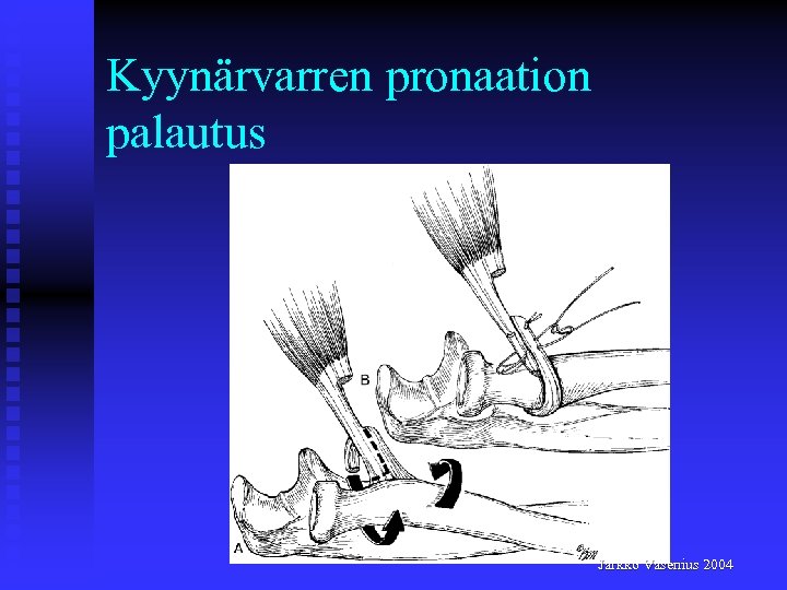Kyynärvarren pronaation palautus Jarkko Vasenius 2004 