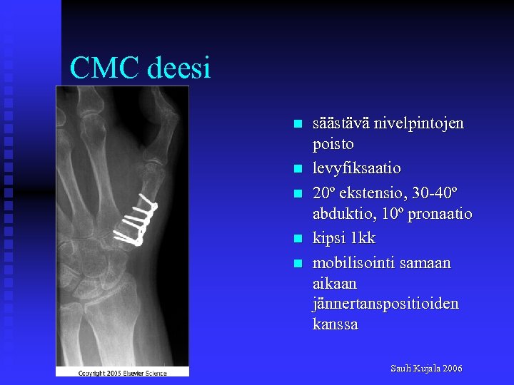 CMC deesi n n n säästävä nivelpintojen poisto levyfiksaatio 20º ekstensio, 30 -40º abduktio,