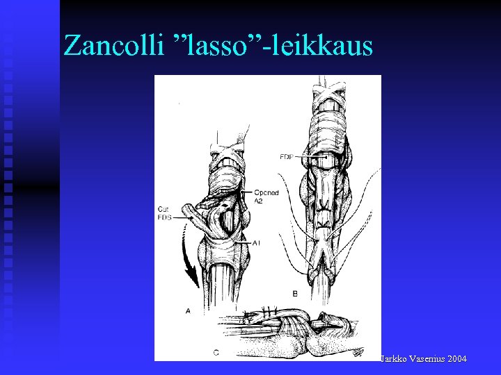 Zancolli ”lasso”-leikkaus Jarkko Vasenius 2004 