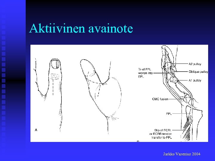 Aktiivinen avainote Jarkko Vasenius 2004 