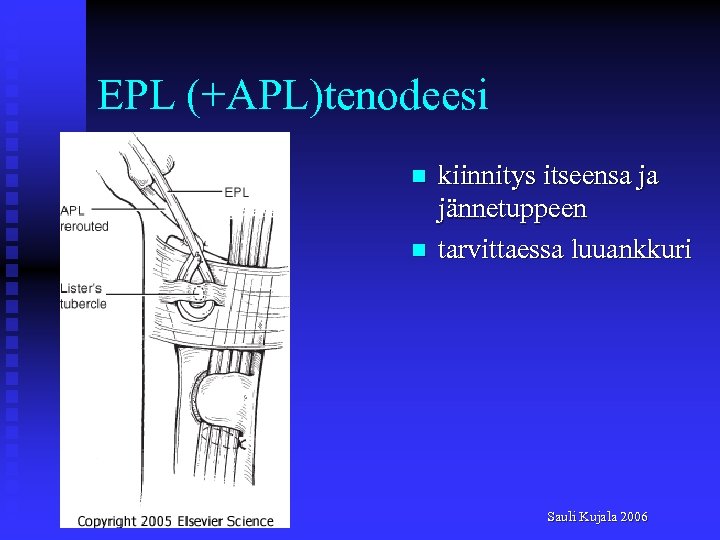 EPL (+APL)tenodeesi n n kiinnitys itseensa ja jännetuppeen tarvittaessa luuankkuri Sauli Kujala 2006 
