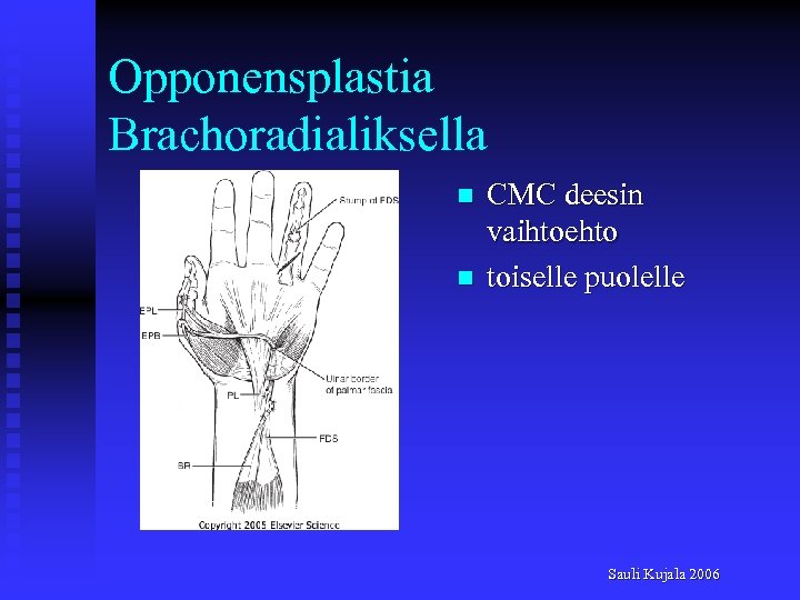 Opponensplastia Brachoradialiksella n n CMC deesin vaihtoehto toiselle puolelle Sauli Kujala 2006 