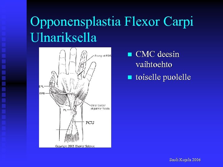 Opponensplastia Flexor Carpi Ulnariksella n n CMC deesin vaihtoehto toiselle puolelle FCU Sauli Kujala