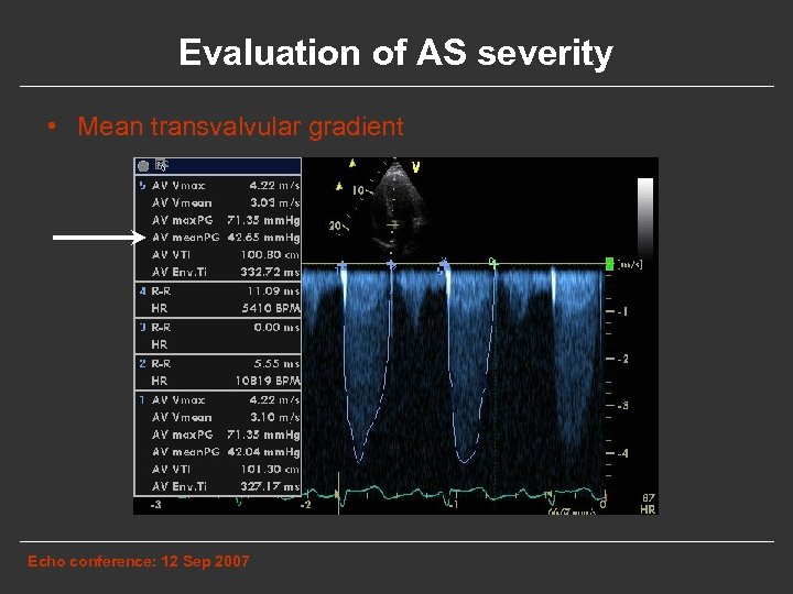 Evaluation of AS severity • Mean transvalvular gradient Echo conference: 12 Sep 2007 