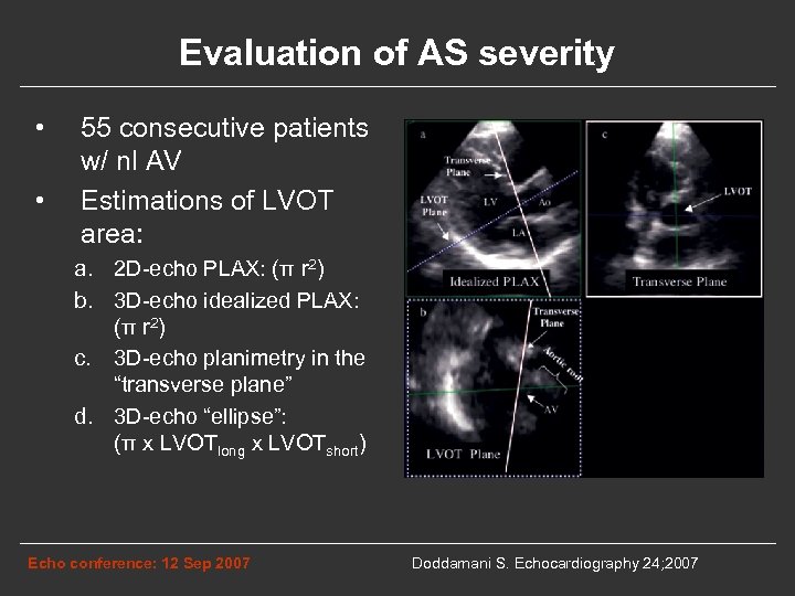 Evaluation of AS severity • • 55 consecutive patients w/ nl AV Estimations of