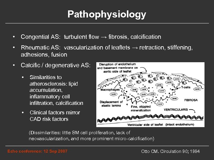 Pathophysiology • Congential AS: turbulent flow → fibrosis, calcification • Rheumatic AS: vascularization of