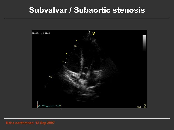 Subvalvar / Subaortic stenosis Echo conference: 12 Sep 2007 