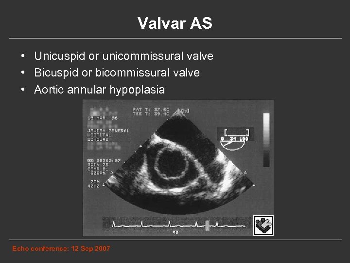 Valvar AS • Unicuspid or unicommissural valve • Bicuspid or bicommissural valve • Aortic