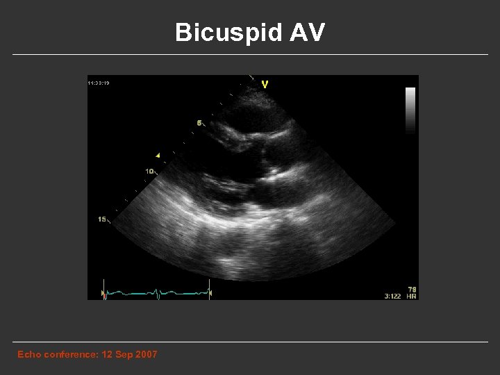Bicuspid AV Echo conference: 12 Sep 2007 