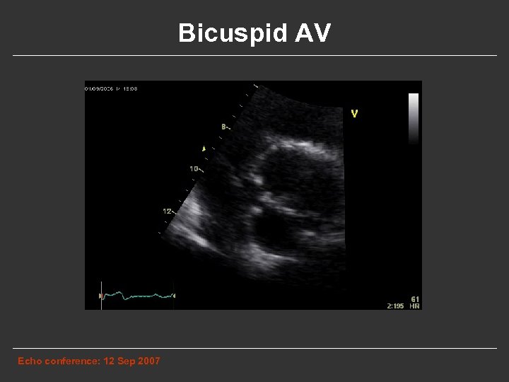 Bicuspid AV Echo conference: 12 Sep 2007 