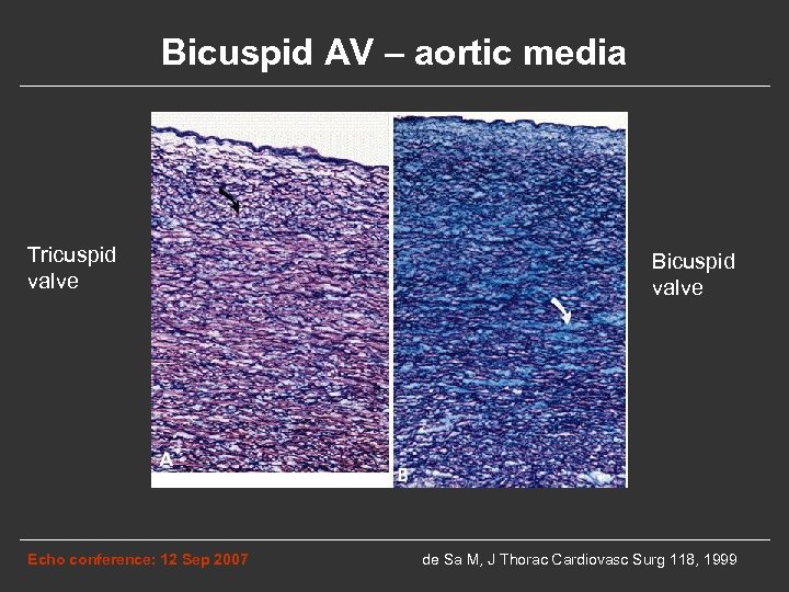 Bicuspid AV – aortic media Tricuspid valve Echo conference: 12 Sep 2007 Bicuspid valve