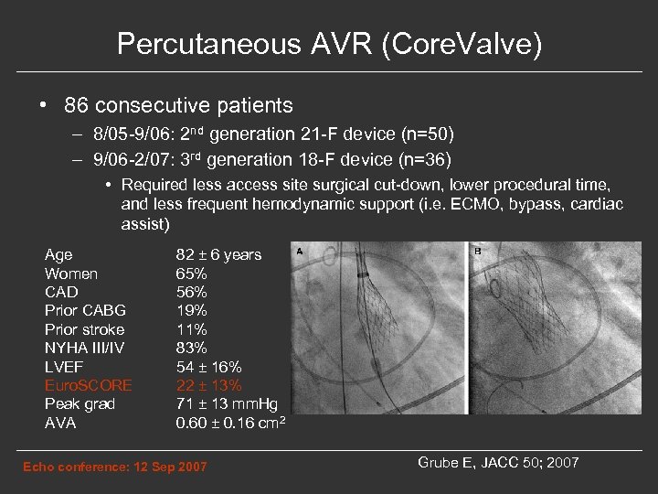 Percutaneous AVR (Core. Valve) • 86 consecutive patients – 8/05 -9/06: 2 nd generation
