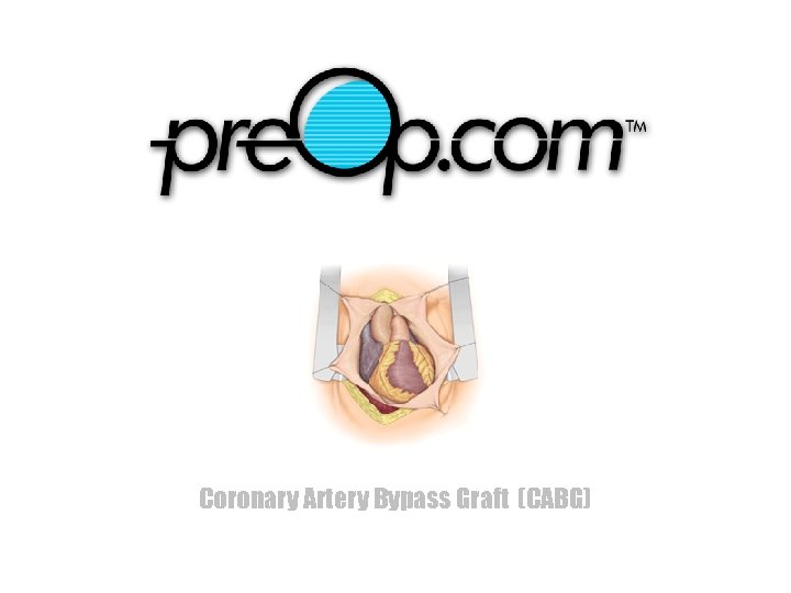Coronary Artery Bypass Graft (CABG) 