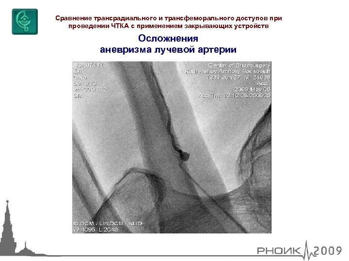 Сравнение трансрадиального и трансфеморального доступов при проведении ЧТКА с применением закрывающих устройств Осложнения аневризма