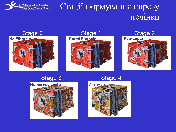 Стадії формування цирозу печінки Stage 0 No Fibrosis Stage 1 Portal Fibrosis Stage 3