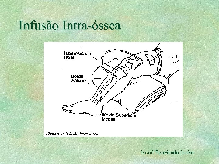 Infusão Intra-óssea israel figueiredo junior 