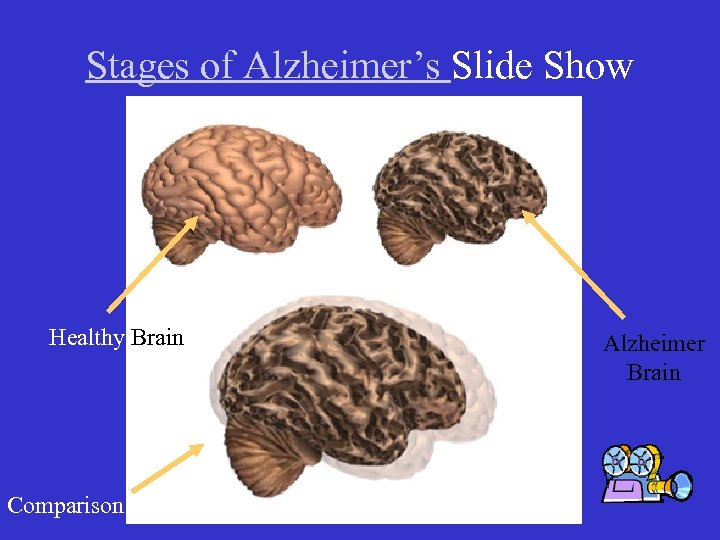 Stages of Alzheimer’s Slide Show Healthy Brain Comparison Alzheimer Brain 