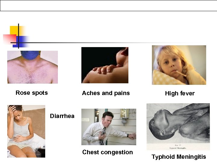  Aches and pains Rose spots High fever Diarrhea Chest congestion Typhoid Meningitis 