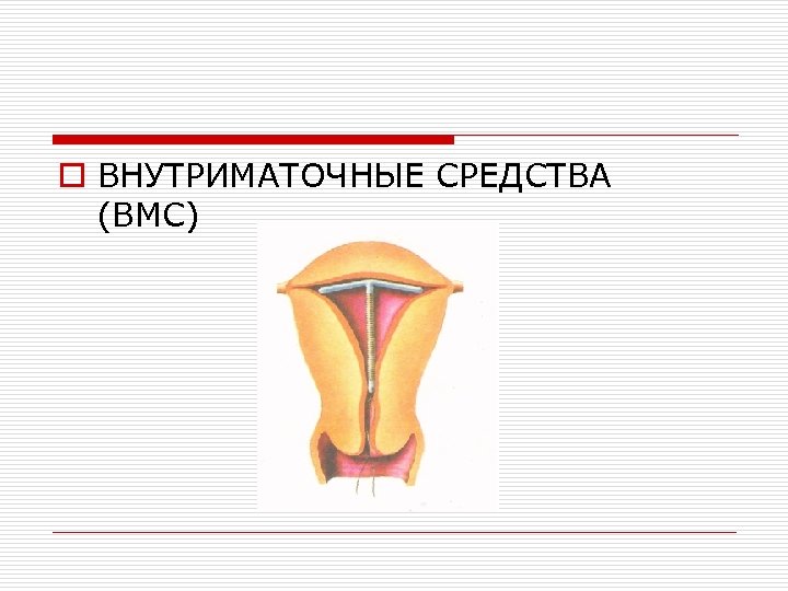 o ВНУТРИМАТОЧНЫЕ СРЕДСТВА (ВМС) 