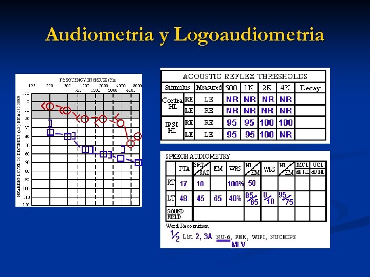 Audiometria y Logoaudiometria 