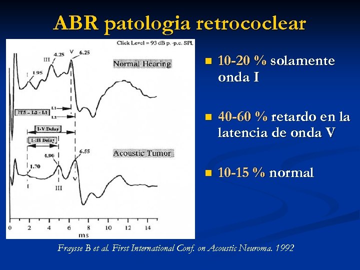 ABR patologia retrococlear n 10 -20 % solamente onda I n 40 -60 %