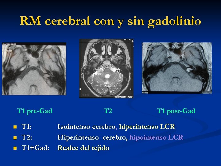 RM cerebral con y sin gadolinio T 1 pre-Gad n n n T 1: