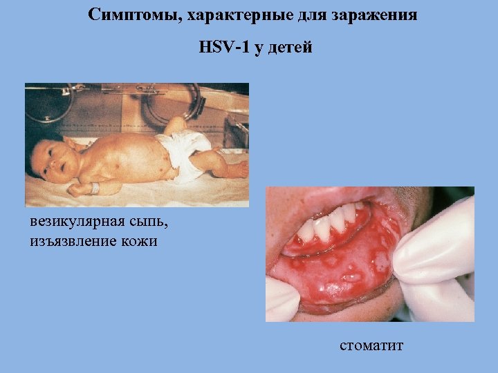 Симптомы, характерные для заражения HSV-1 у детей везикулярная сыпь, изъязвление кожи стоматит 