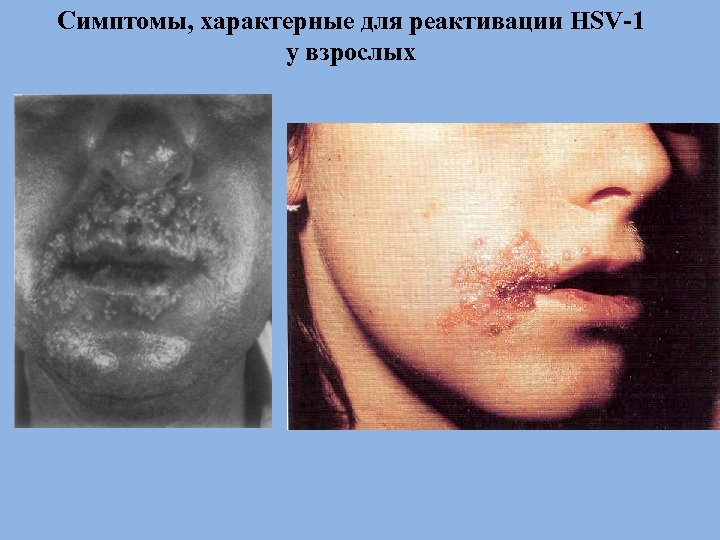 Симптомы, характерные для реактивации HSV-1 у взрослых 