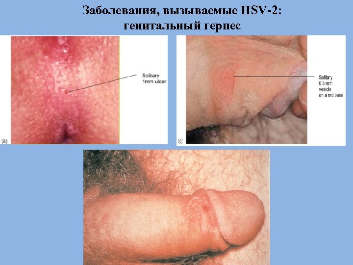 Заболевания, вызываемые HSV-2: генитальный герпес 