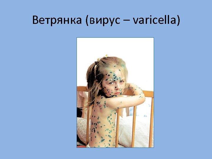 Ветрянка (вирус – varicella) 