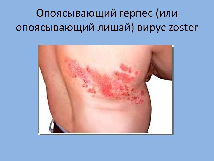 Опоясывающий герпес (или опоясывающий лишай) вирус zoster 
