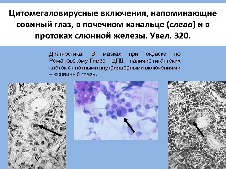 Цитомегаловирусные включения, напоминающие совиный глаз, в почечном канальце (слева) и в протоках слюнной железы.
