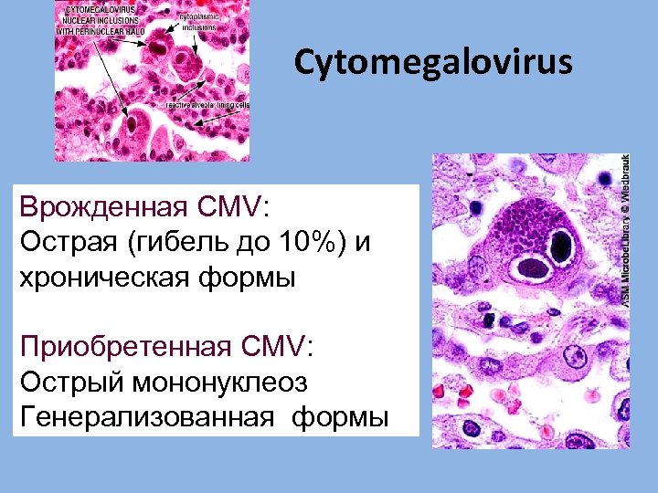 Сytomegalovirus Врожденная CMV: Острая (гибель до 10%) и хроническая формы Приобретенная CMV: Острый мононуклеоз