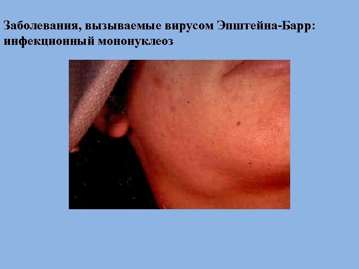 Заболевания, вызываемые вирусом Эпштейна-Барр: инфекционный мононуклеоз 