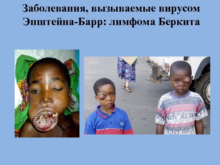 Заболевания, вызываемые вирусом Эпштейна-Барр: лимфома Беркита 