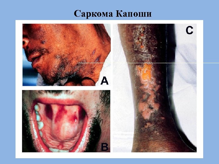 Саркома Капоши 