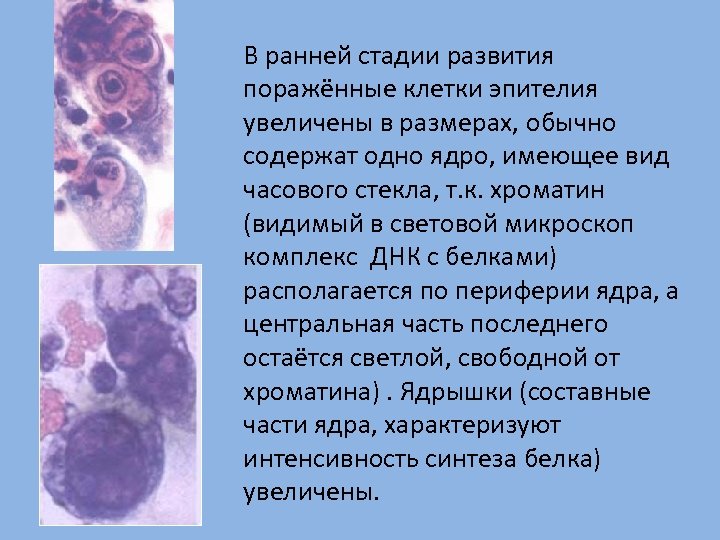 В ранней стадии развития поражённые клетки эпителия увеличены в размерах, обычно содержат одно ядро,