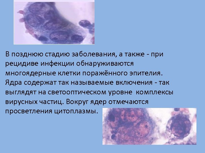 В позднюю стадию заболевания, а также - при рецидиве инфекции обнаруживаются многоядерные клетки поражённого