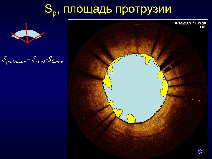 Sp, площадь протрузии Sprotrusion= Sstent-Slumen 