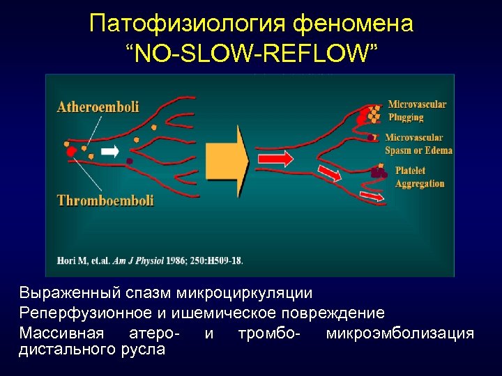 Патофизиология феномена “NO-SLOW-REFLOW” Выраженный спазм микроциркуляции Реперфузионное и ишемическое повреждение Массивная атеро- и тромбо-