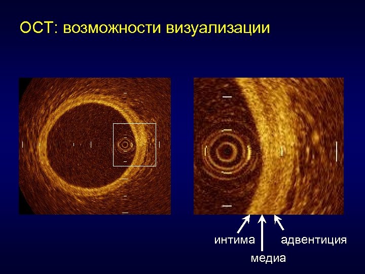 ОСТ: возможности визуализации интима адвентиция медиа 