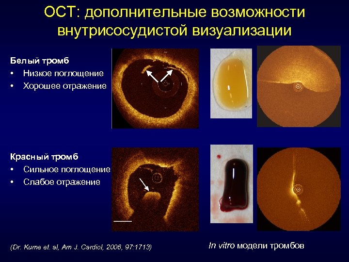 ОСТ: дополнительные возможности внутрисосудистой визуализации Белый тромб • Низкое поглощение • Хорошее отражение Красный