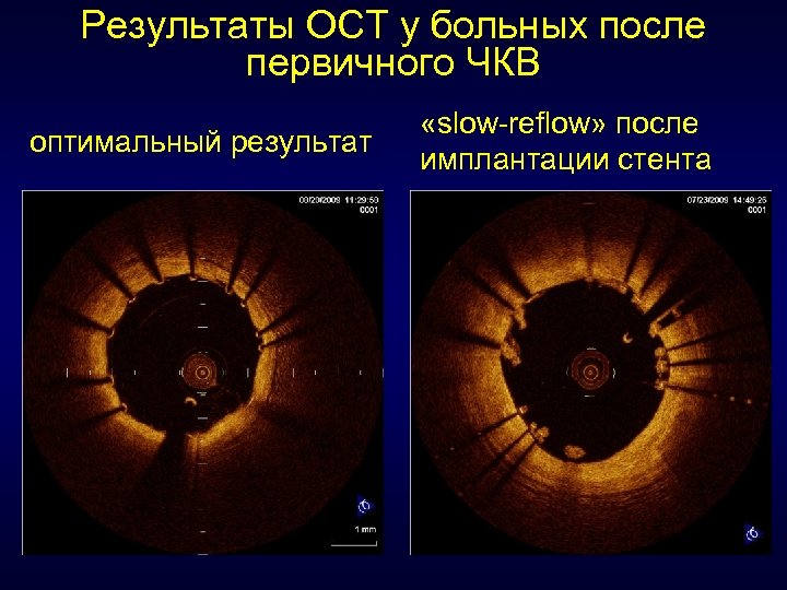 Результаты ОСТ у больных после первичного ЧКВ оптимальный результат «slow-reflow» после имплантации стента 