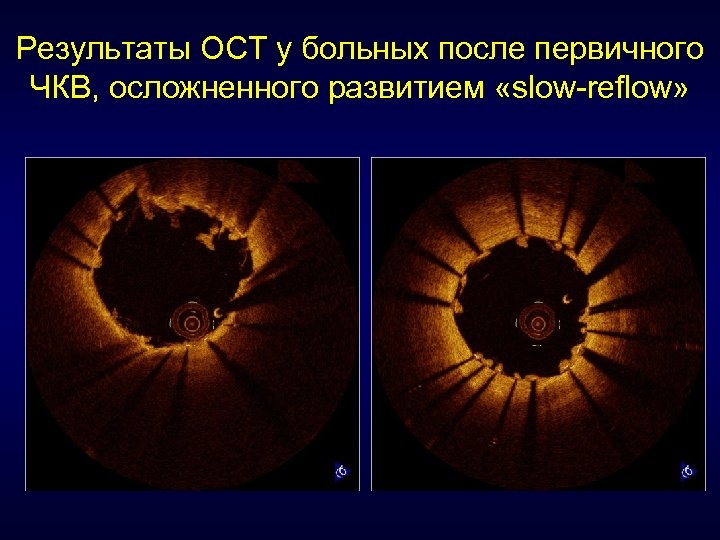 Результаты ОСТ у больных после первичного ЧКВ, осложненного развитием «slow-reflow» 