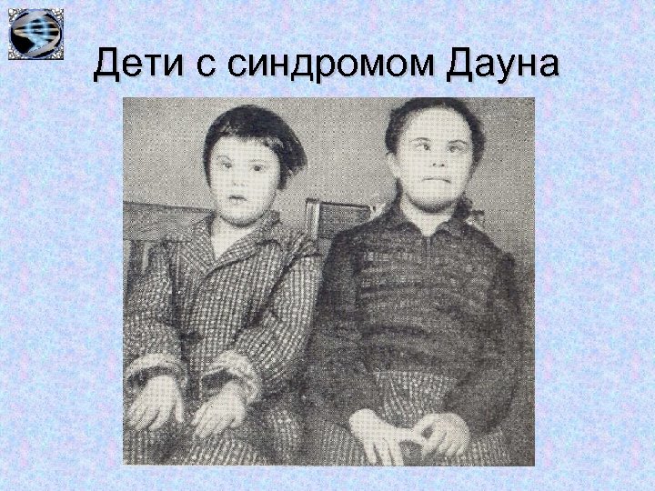 Дети с синдромом Дауна 