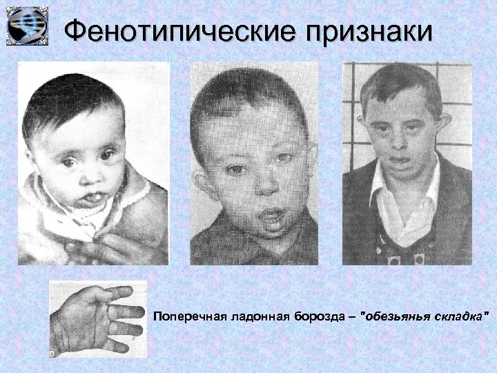 Фенотипические признаки Поперечная ладонная борозда – 