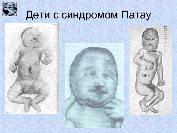 Дети с синдромом Патау 