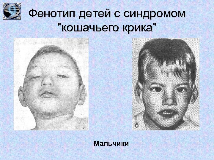 Фенотип детей с синдромом 