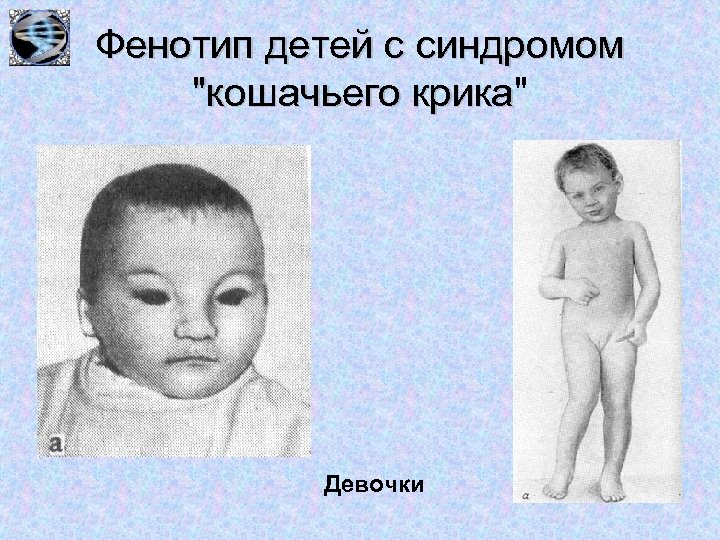 Фенотип детей с синдромом 