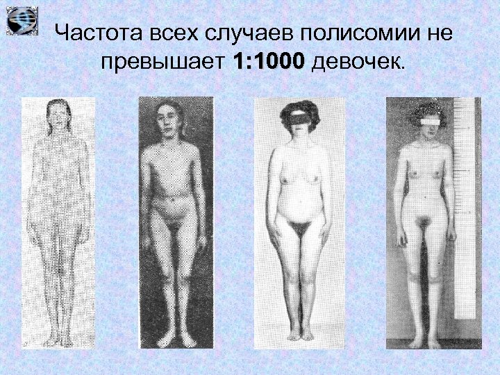 Частота всех случаев полисомии не превышает 1: 1000 девочек. 
